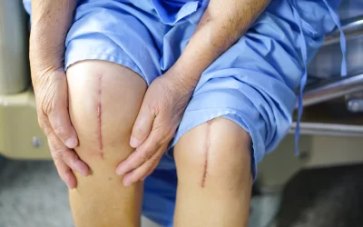 5 Myths & Facts related to Knee Replacement Surgery